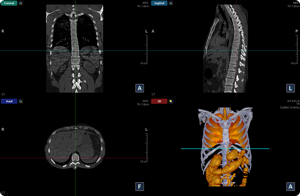 Axial, Coronal, Sagittal and 3D View