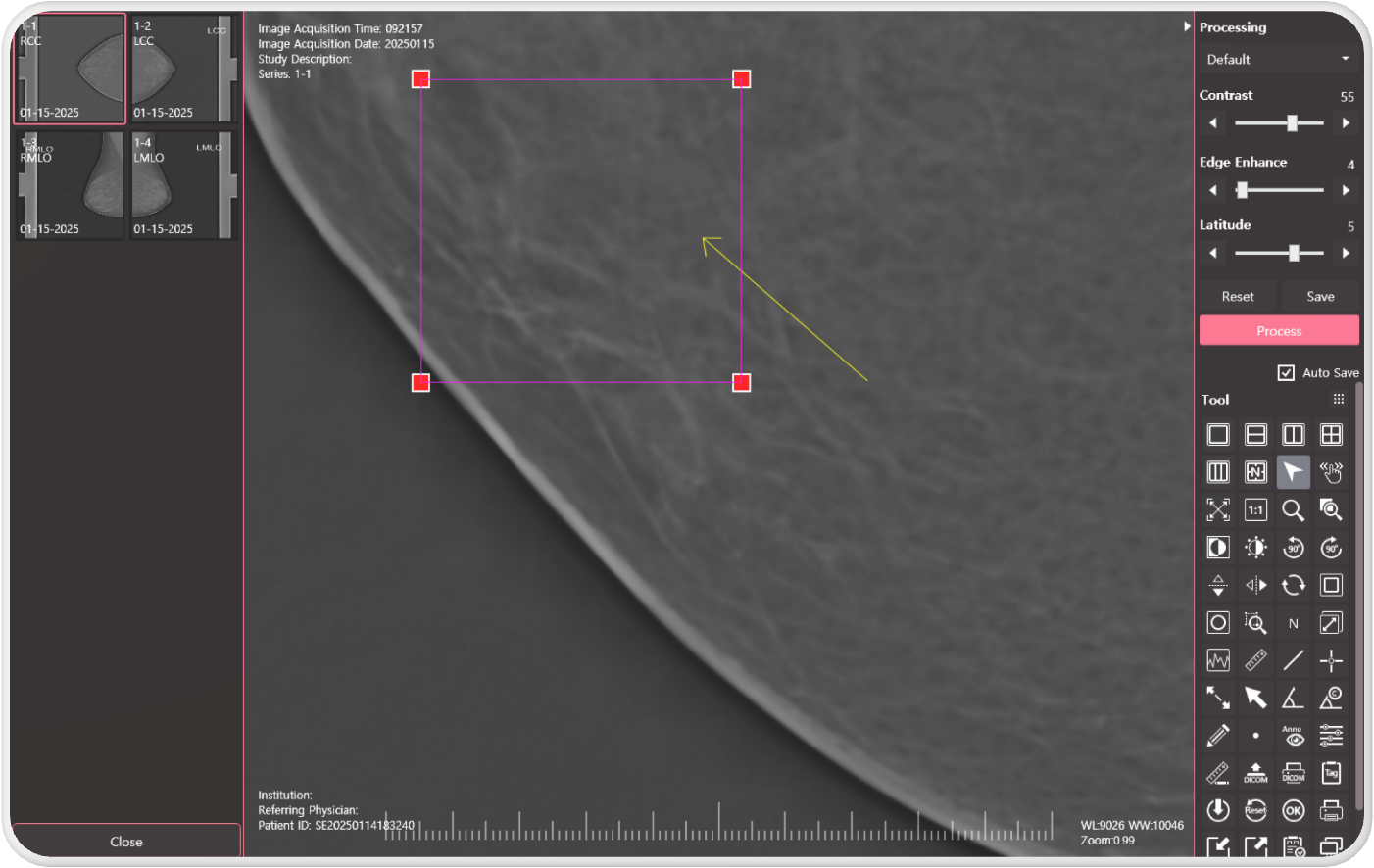 Image Optimization for Breast Tissue