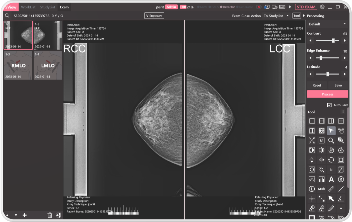 Enhanced Workflow for Mammography